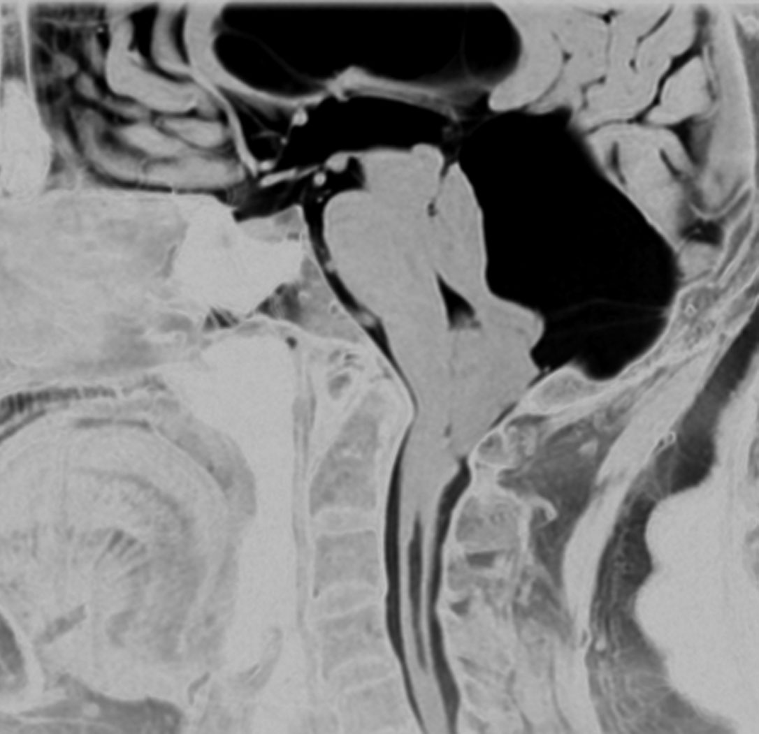くも膜のう胞 嚢胞 Arachnoid Cyst 脳外科医 澤村豊のホームページ