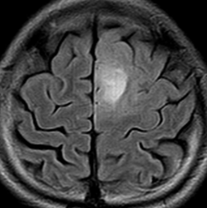 グリオーマの悪性転化 Malignant Transformation セカンダリー グリオブラストーマ Secondary Glioblastoma 脳外科医 澤村豊のホームページ