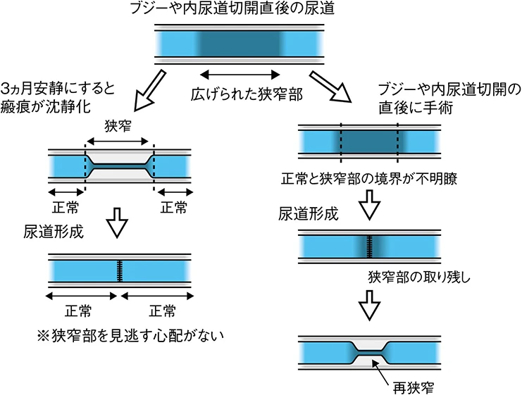 尿道の安静の有無による狭窄部評価の違いを示す図