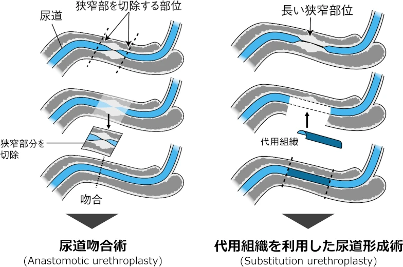尿道形成術の分類を示す図