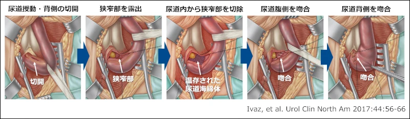 Non-transecting anastomotic urethroplasty（NTAU）の手術手順のイメージ図