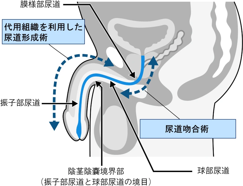 狭窄の部位と術式の選択を示す図
