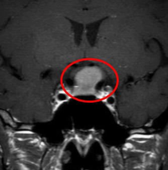 髄膜腫症例１の術前MRI
