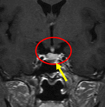 髄膜腫症例１の術後MRI