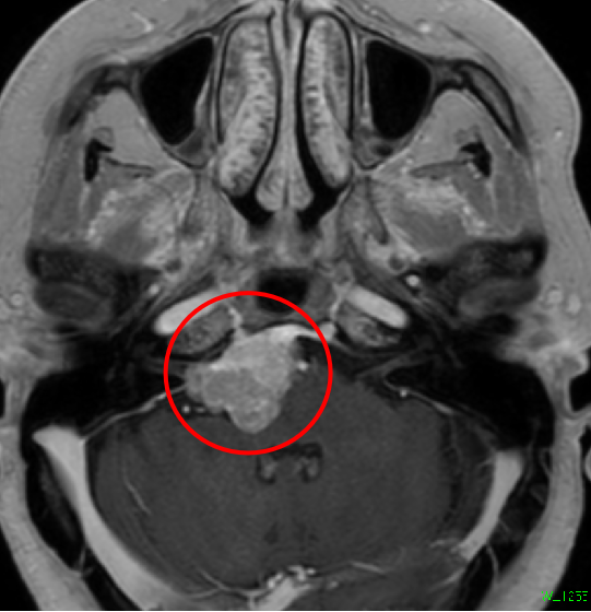 髄膜腫症例２の術前MRI
