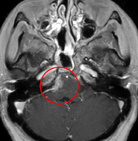 髄膜腫症例２の術後MRI
