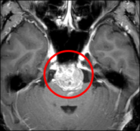 脊索腫症例の術前MRI