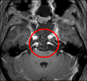 脊索腫症例の術後MRI