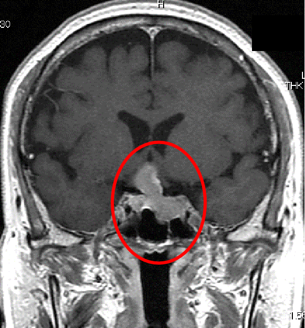 下垂体腺腫症例2の術前MRI
