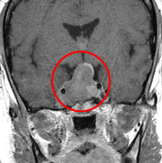下垂体腺腫症例1の術前MRI