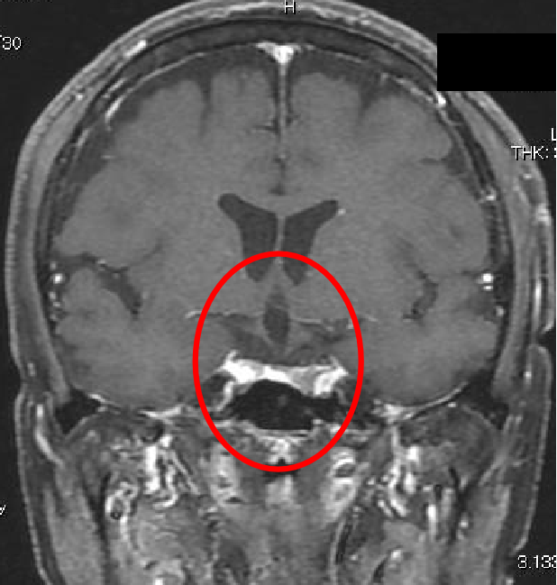 下垂体腺腫症例2の術後MRI