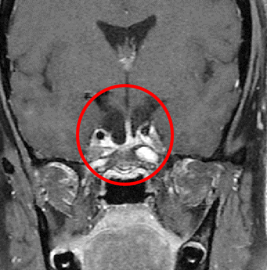 下垂体腺腫症例1の術後MRI