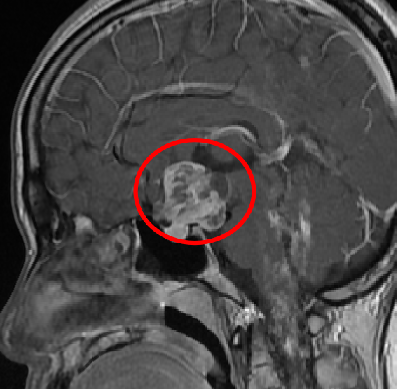 頭蓋咽頭腫の術前MRI