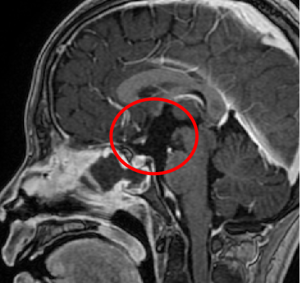 頭蓋咽頭腫の術後MRI