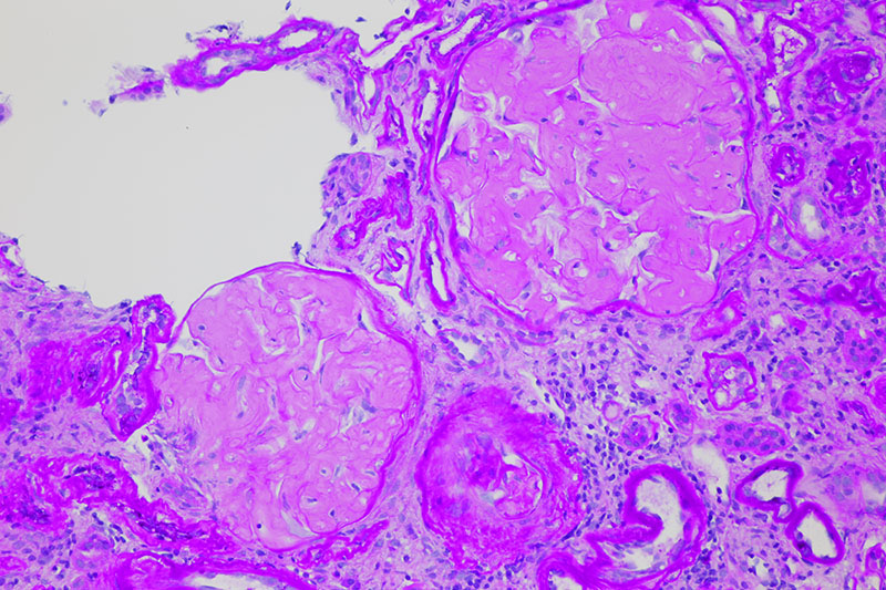 膜性糸球体腎炎の患者の今後の見通しはどうなりますか?