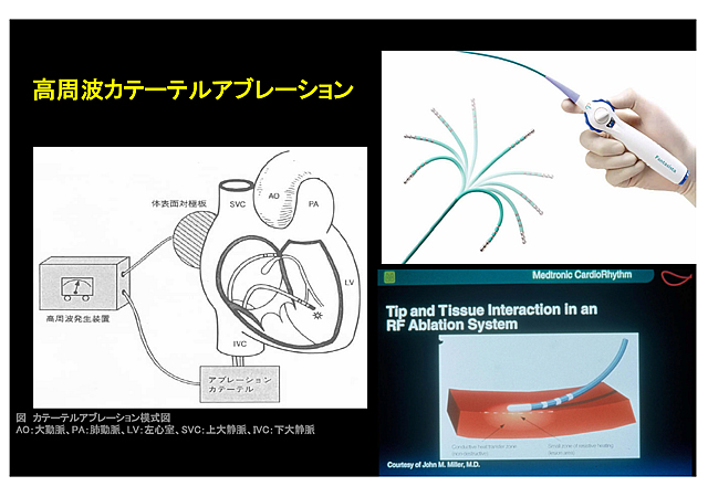 頻脈性不整脈に対する高周波カテーテルアブレーション | 日本不整脈 