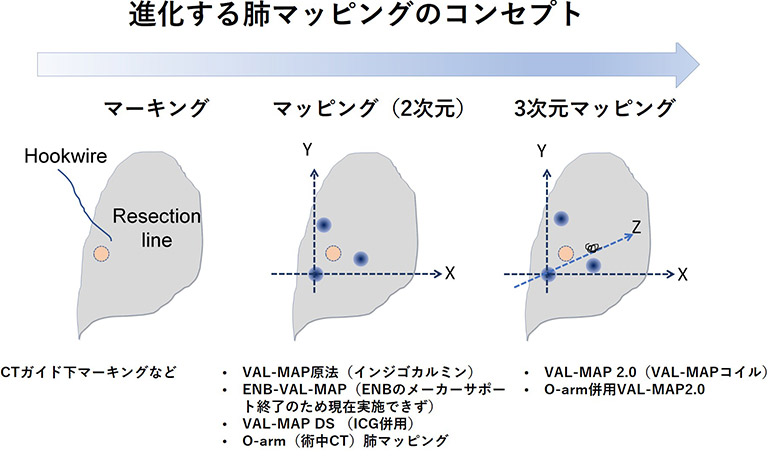 肺マッピングと精密ナビゲーション肺切除手術【呼吸器外科】｜東京大学