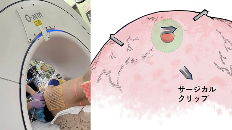 肺マッピングと精密ナビゲーション肺切除手術【呼吸器外科】｜東京大学