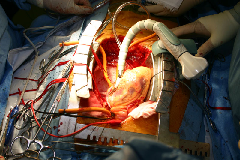 人工心肺非使用冠動脈バイパス 手術 手技と解説 日本心臓血管外科学会