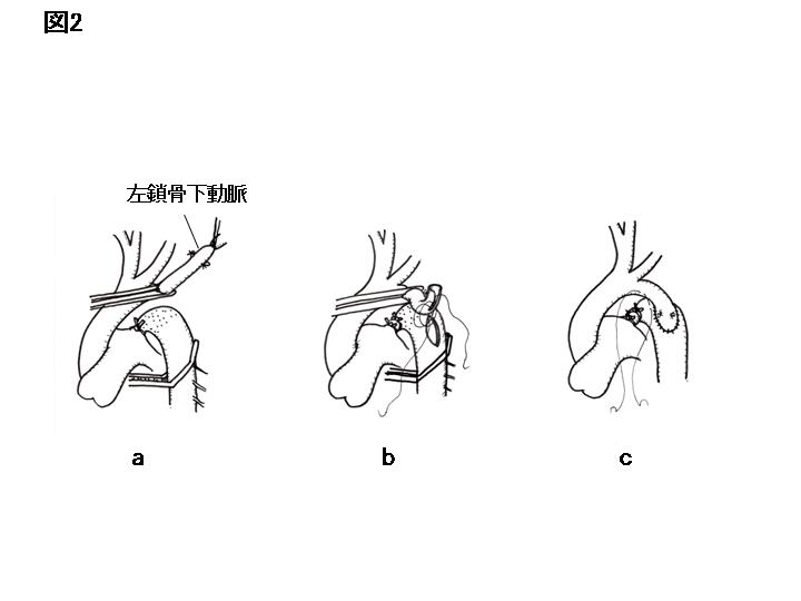 大動脈縮窄 離断症 手術 手技と解説 日本心臓血管外科学会