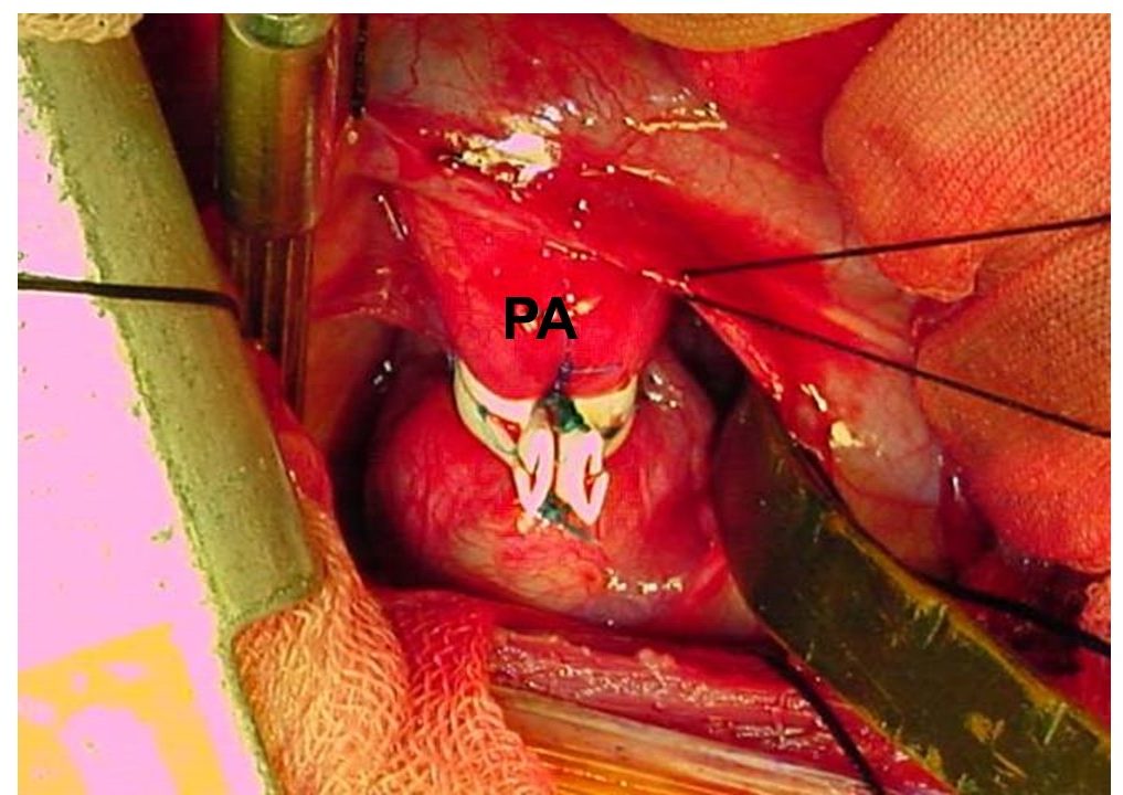 図4: 肺動脈絞扼術