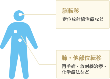 脳転移:定位放射線治療など、肺・他部位転移:再手術・放射線治療・化学療法など