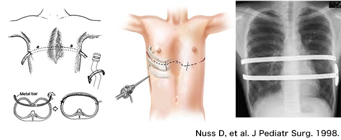 Nuss D, et al. J Pediatr Surg. 1998.