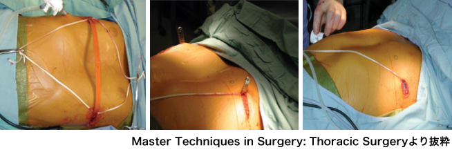 Master Techniques in Surgery: Thoracic Surgeryより抜粋