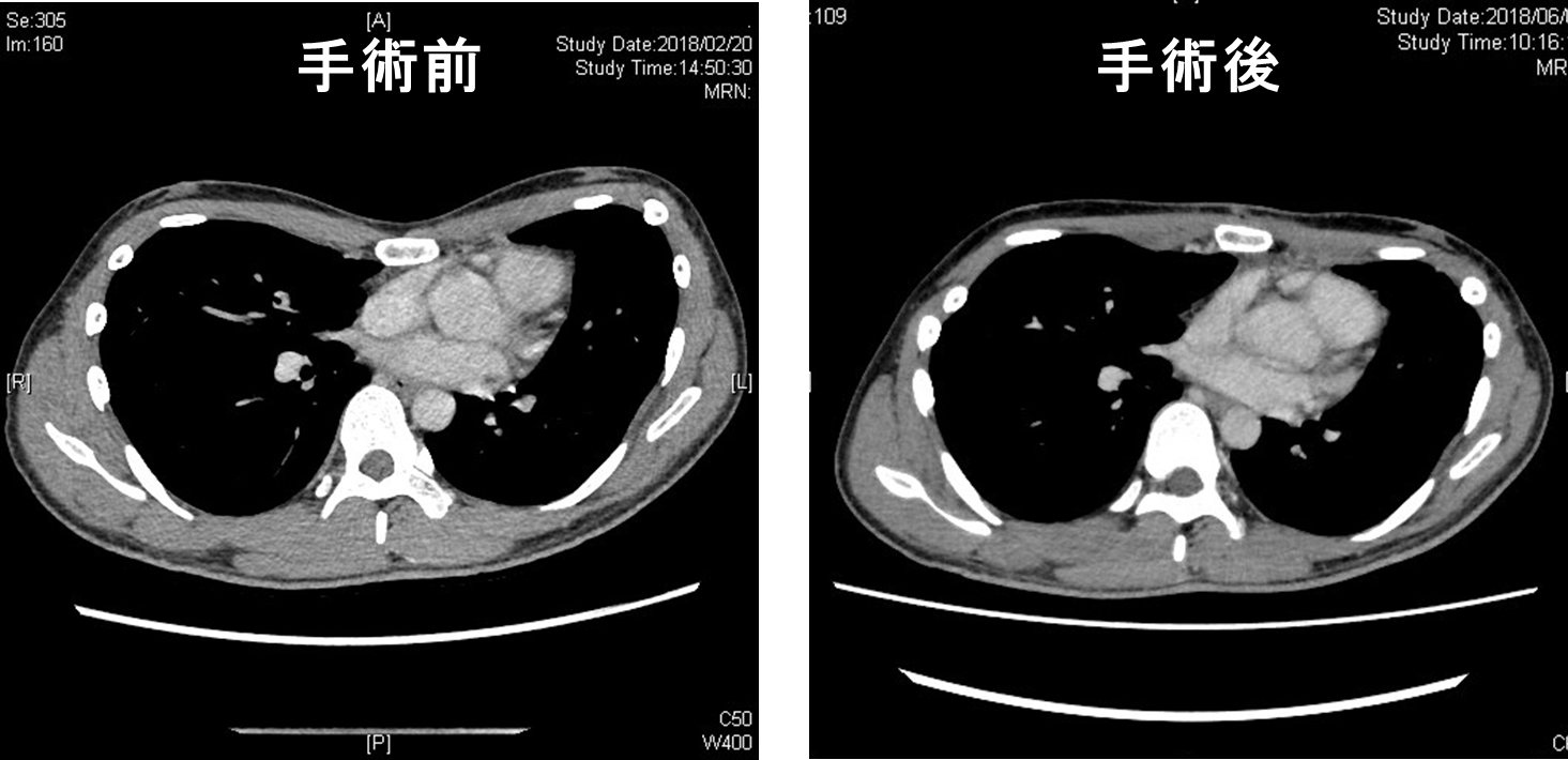 漏斗胸手術