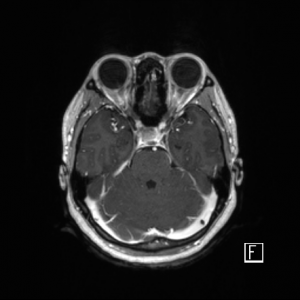 成長ホルモン産生下垂体腫瘍（アクロメガリー、先端巨大症）の画像です。下垂体はトルコ鞍という器の中に収まっていますが、この下垂体の中から腫瘍が発生します。