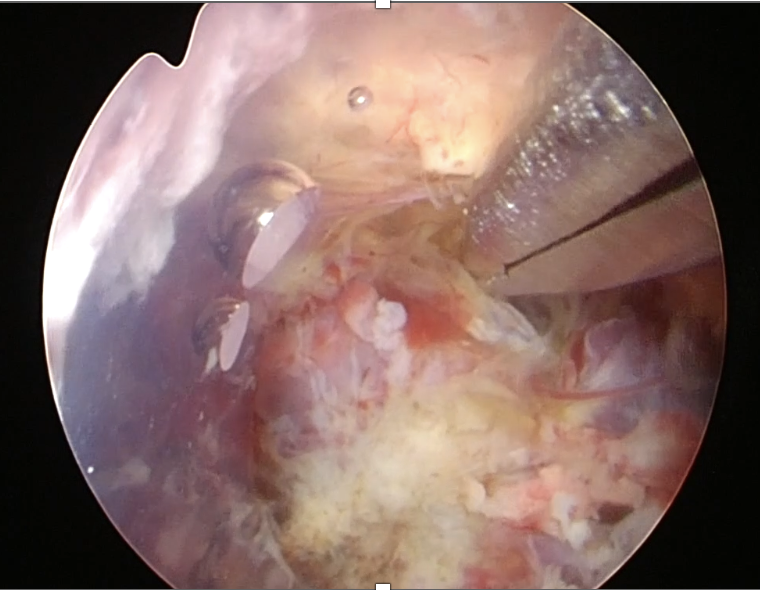 海綿状血管腫の内視鏡手術中です。
画面下半分が海綿状血管腫です。