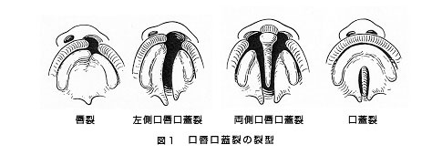 口唇口蓋裂 東京大学医学部附属病院 口腔顎顔面外科 矯正歯科