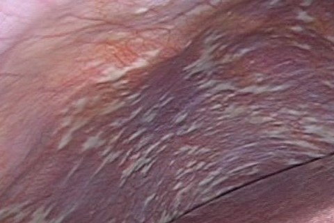 くも膜下腔内化学療法中に何が期待できますか?