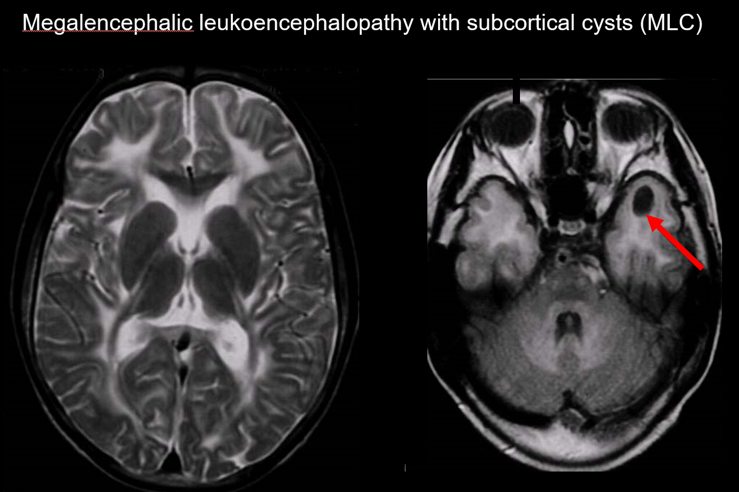 図7. Megalencephalic leukoencephalopathy with subcortical cysts、学童男性。生後６ヶ月から頭囲拡大 (+4SD) を認め、２歳時失調性歩行、振戦、痙性。白質に広範なT2高信号を認める。FLAIR画像にて左側頭葉前部に嚢胞を認める。