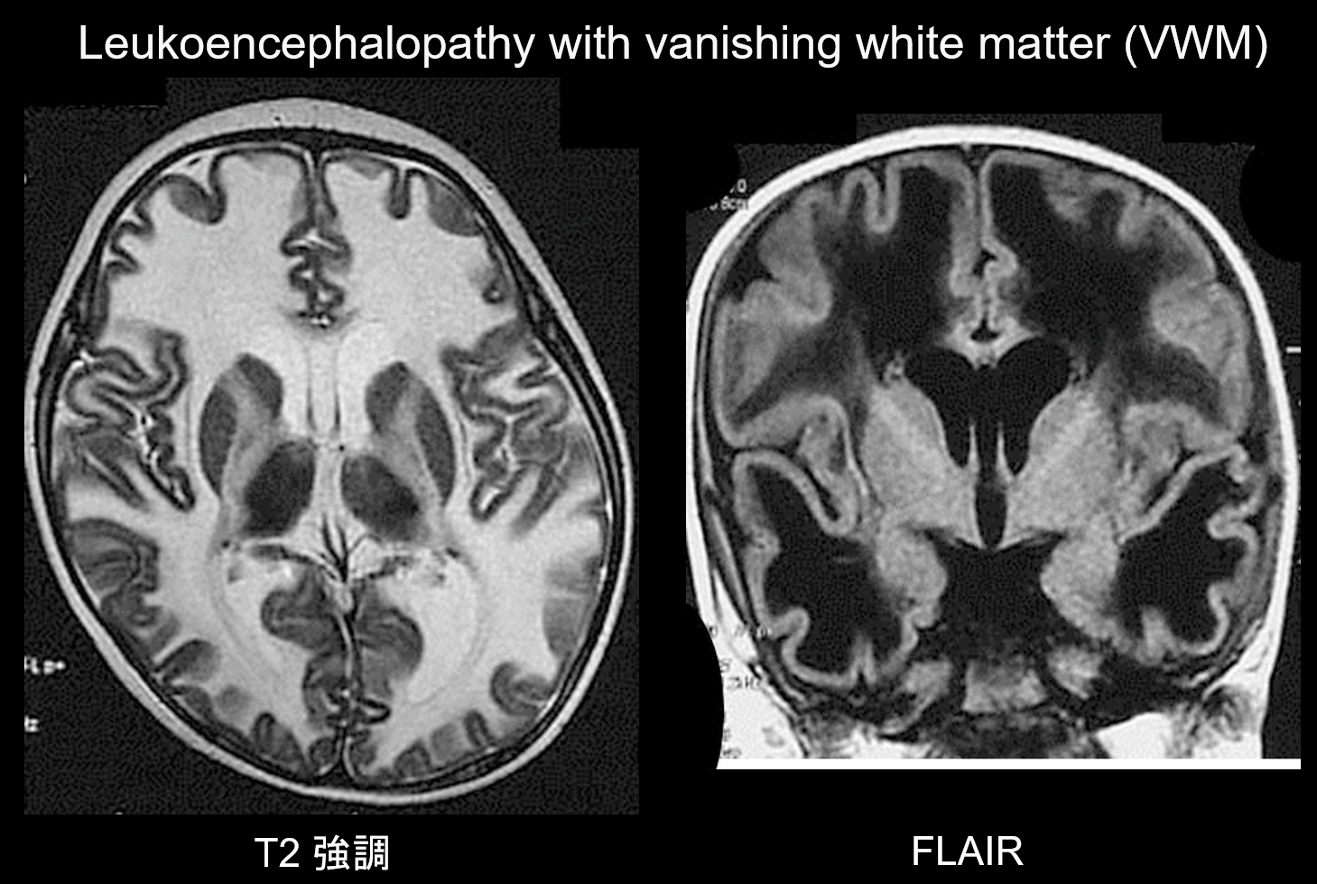 図8. Leukoencephalopathy with vanishing white matter、乳児、発達退行。