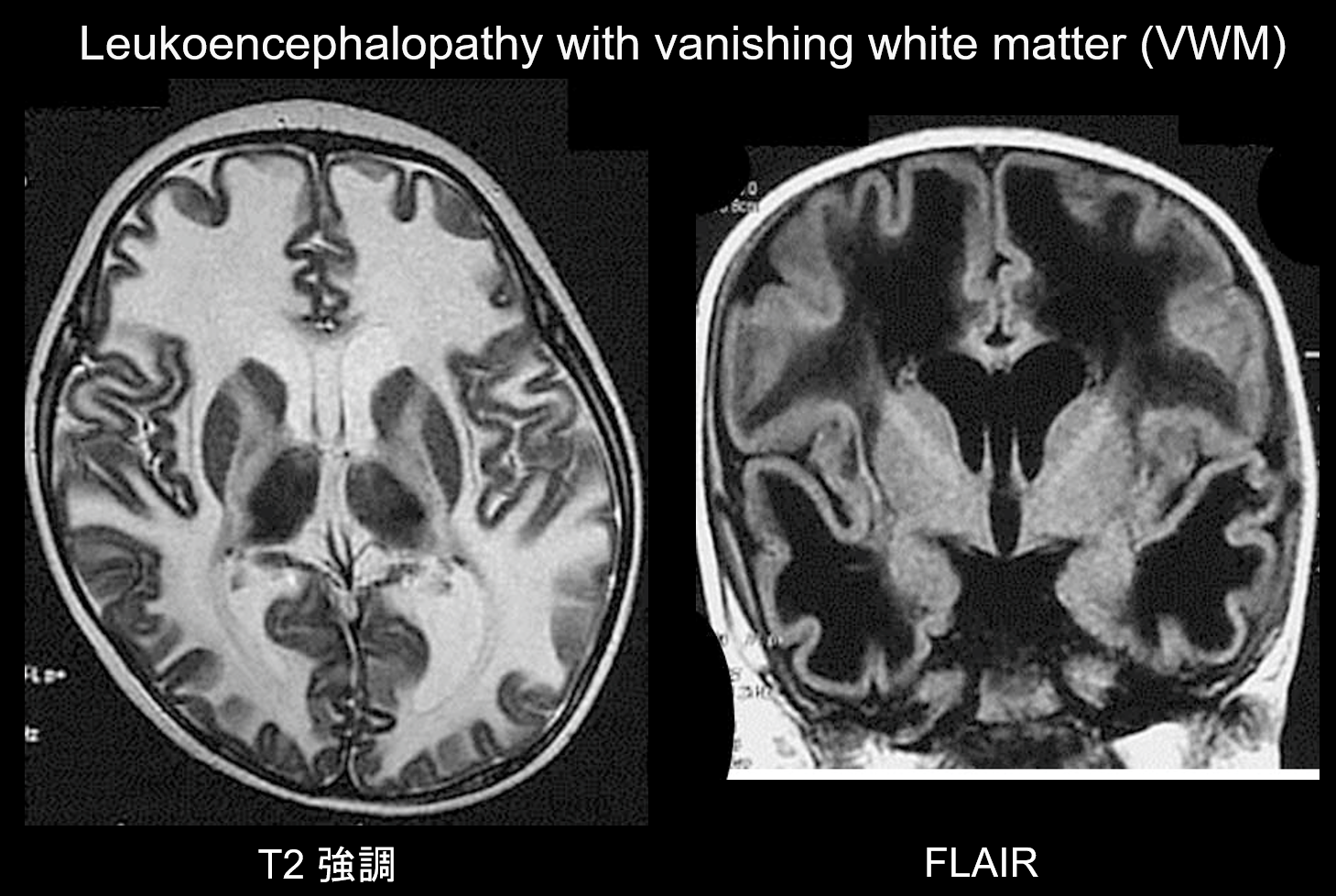 ketogenic-diets-for-white-matter-disease-mental-health-keto