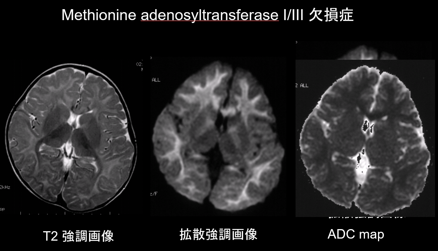 図9. Methionine adenosyltransferase I/III 欠損症、幼児男性、高メチオニン血症。白質は、T2強調画像にて広範な高信号、拡散強調画像では著明な高信号を呈する。ADC mapではADC低下を認める。