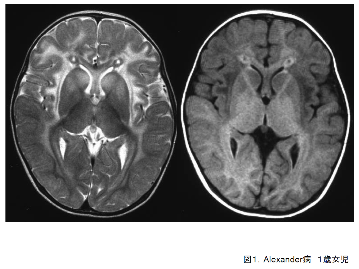 図1. Alexander病．１歳女児．T2強調画像．前頭葉優位に白質高信号．基底核にも高信号．