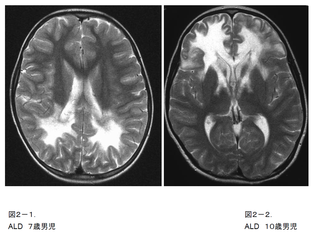 大脳白質障害の臨床診断について | 厚生労働省科学研究費補助金 難治性