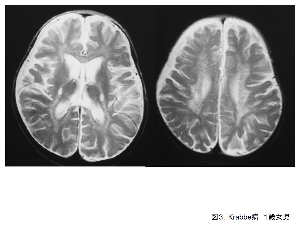 図3. Krabbe病．１歳女児．T2強調画像．内包から深部白質に高信号．