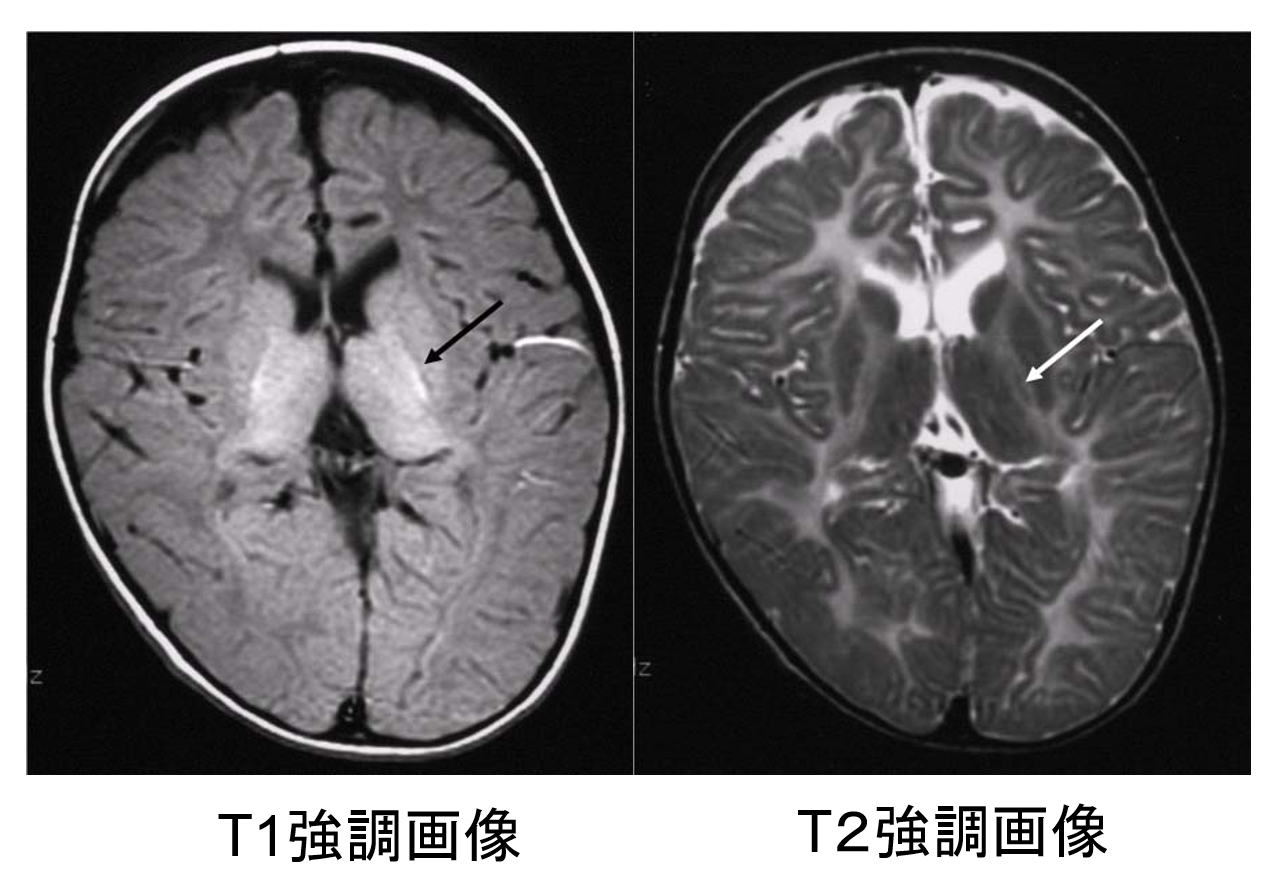 図1　Pelizaeus-Merzbacher 病（古典型, PLP遺伝子重複）10歳代男性。生後３か月より水平性眼振、頭部の振戦を認めた。頚定８カ月，寝返り３歳、言語は未獲得。T1低信号・T2高信号を認め、新生児期の正常画像に近似する。内包後脚にのみ髄鞘化を反映したT1高信号・T2低信号（矢印）を認める。