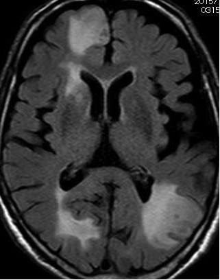 図２；転移性脳腫瘍（FLAIR像）