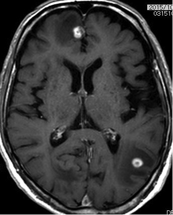 図２；転移性脳腫瘍（造影）