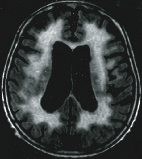 Figure 3. Binswanger  disease（FLAIR image）