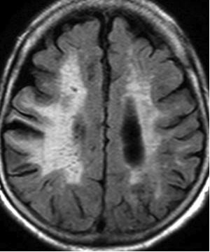 Figure 4. Cerebral  amyloid angiopathy
