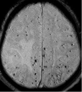 図４；脳アミロイドアンギオT2