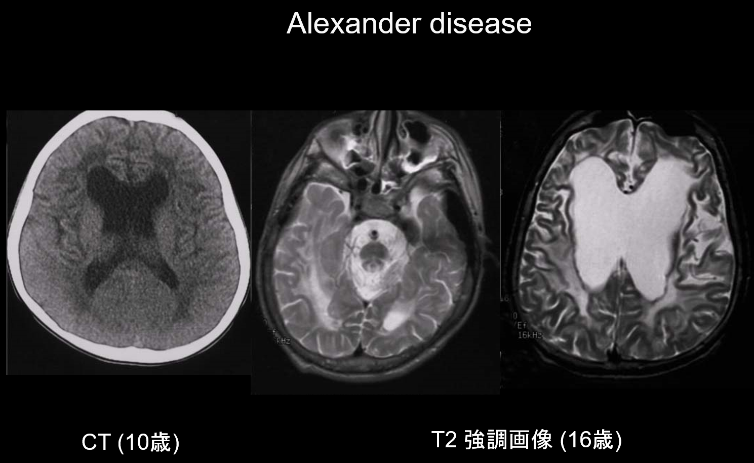 図2. Alexander disease、10歳代男性、発達遅滞、退行、頭囲拡大 (+5SD)、てんかん、痙性。10歳時のCTでは前頭部白質の低信号、側脳室前角の拡大を認める。16歳時のT2強調画像では前頭優位の白質ならびに脳幹の信号異常、萎縮を認める。
