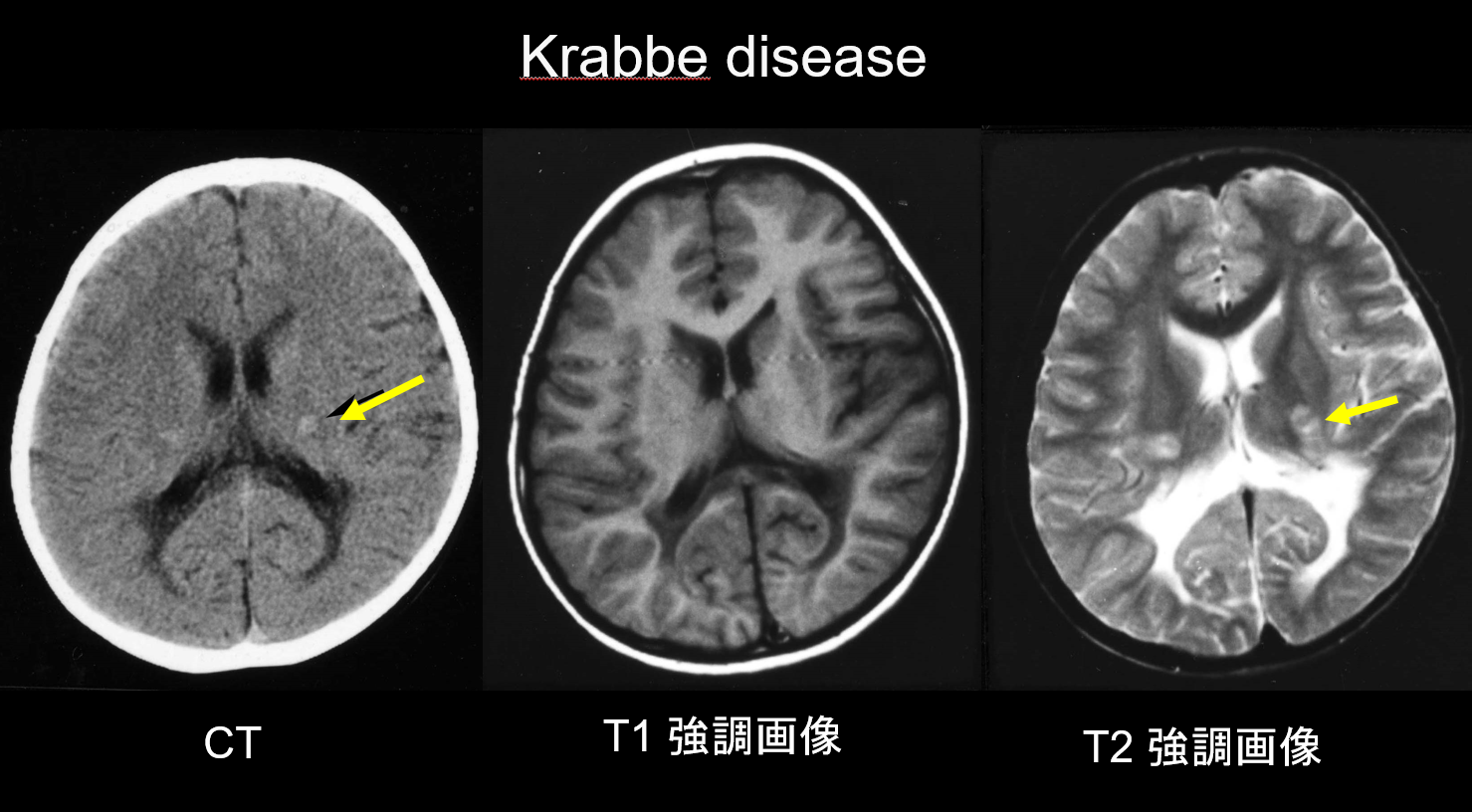図3. Krabbe disease、幼児男性、知的・運動退行。CTにて内包後脚に高吸収域（矢印）を認める。T1, T2強調画像では、内包後脚（矢印）、側脳室後角周囲白質、脳梁膨大部に信号異常を認める。U fiberは保持されている。（和歌山大学教育学部、小野次郎先生のご厚意による）