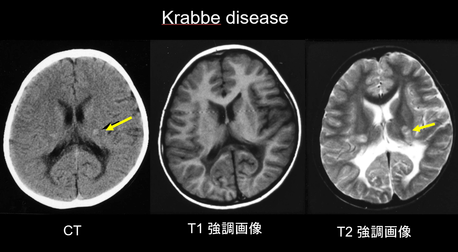 白質異常の画像診断 | 厚生労働省科学研究費補助金 難治性疾患等政策 