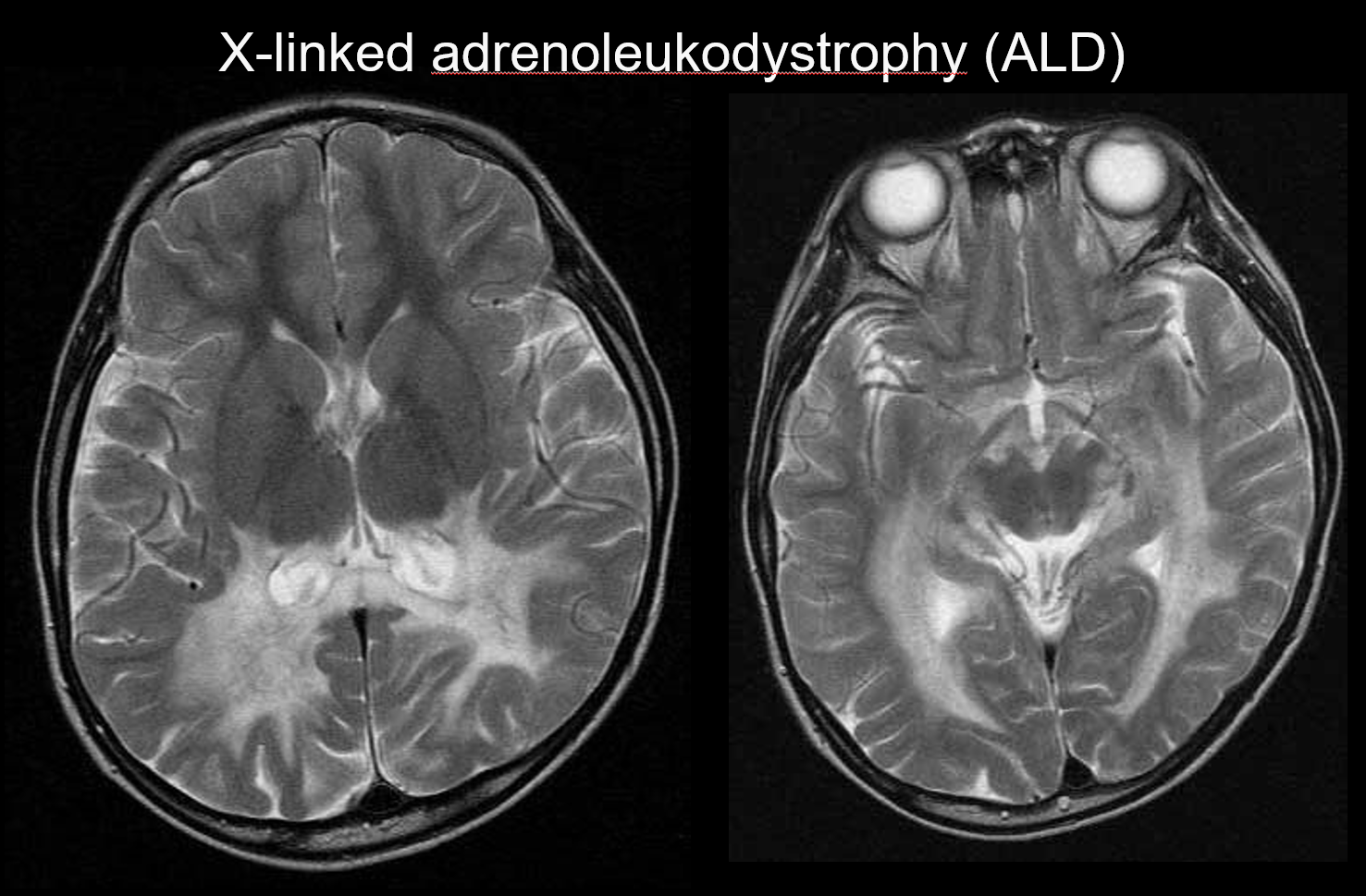 図4. X-linked adrenoleukodystrophy (ALD) 学童男性、行動異常、視力障害。後頭部優位の白質病変を認める。